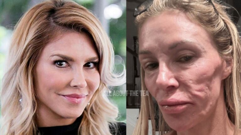 Brandi Glanville plonge dans une « profonde dépression » à cause d’une horrible défiguration du visage !