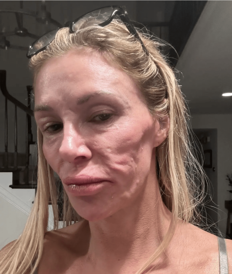 Brandi Glanville dit que sauter parasite sur son visage fuit de l'acide dans sa bouche et éroder ses dents