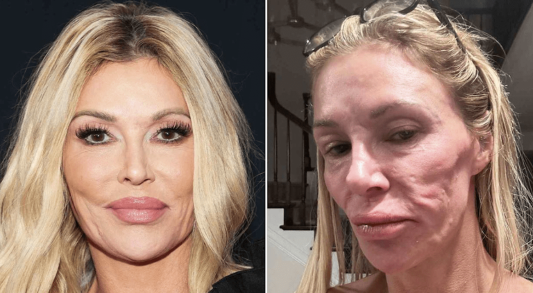 La santé de Brandi Glanville diminue alors qu'elle est à nouveau hospitalisée pour une bataille parasite faciale!